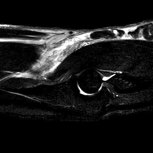Distal Biceps Rupture MRI